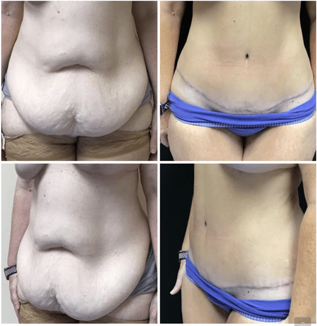 Formal Tummy Tuck