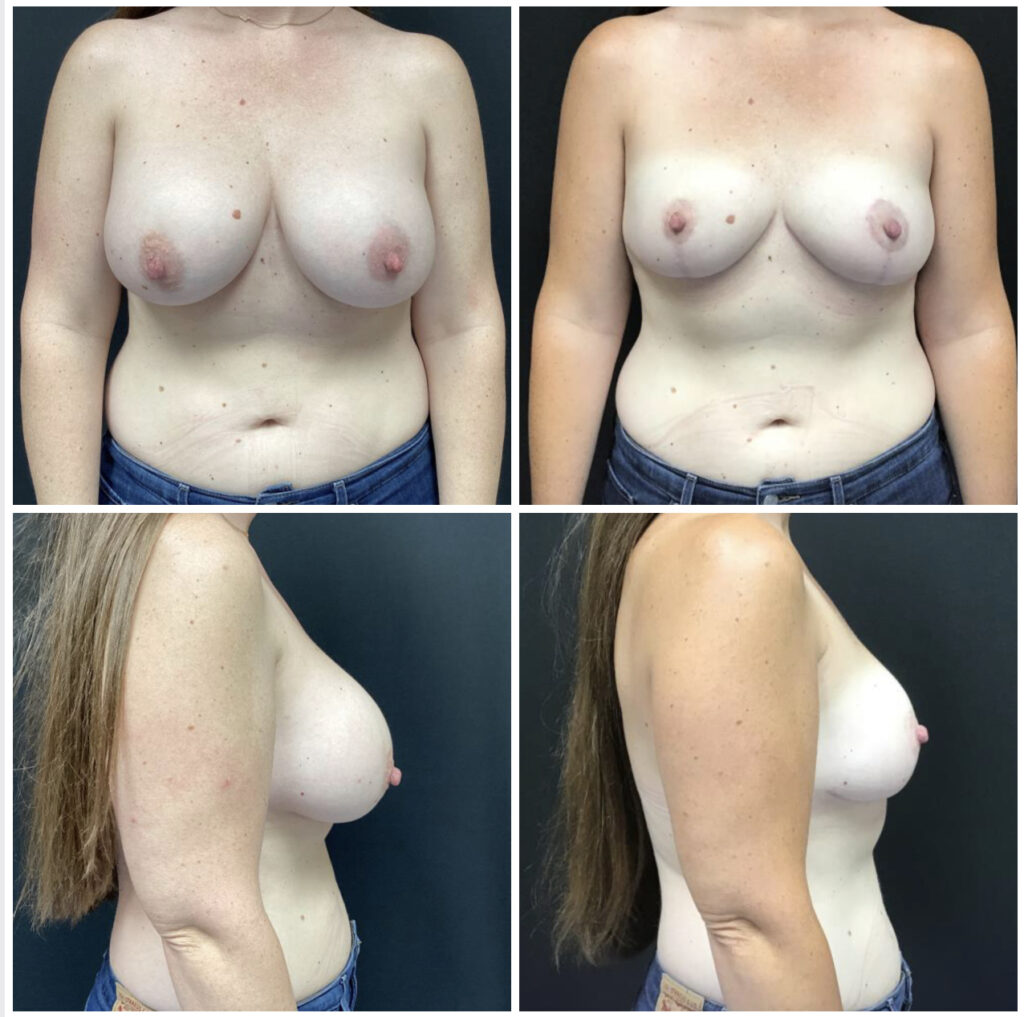 This image has an empty alt attribute; its file name is Breast-Implant-Removal-Case-Study-Photos-1024x1017.jpg