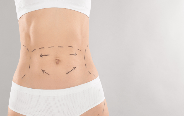 Tummy Tuck