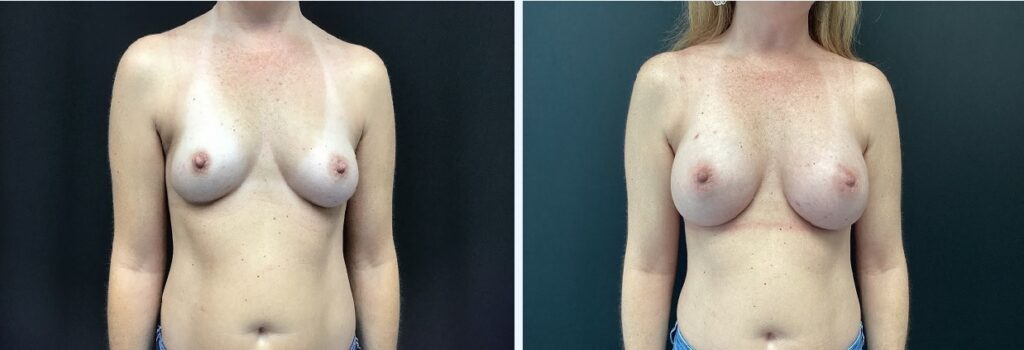 breast augmentation