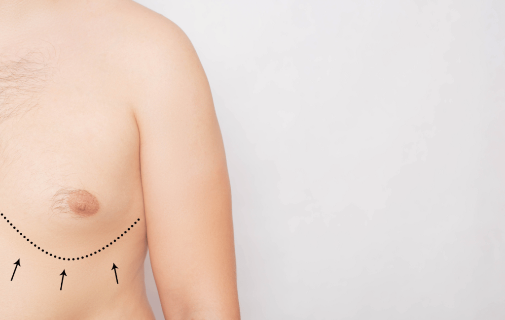 Gynecomastia: A Male Cosmetic Surgical Solution