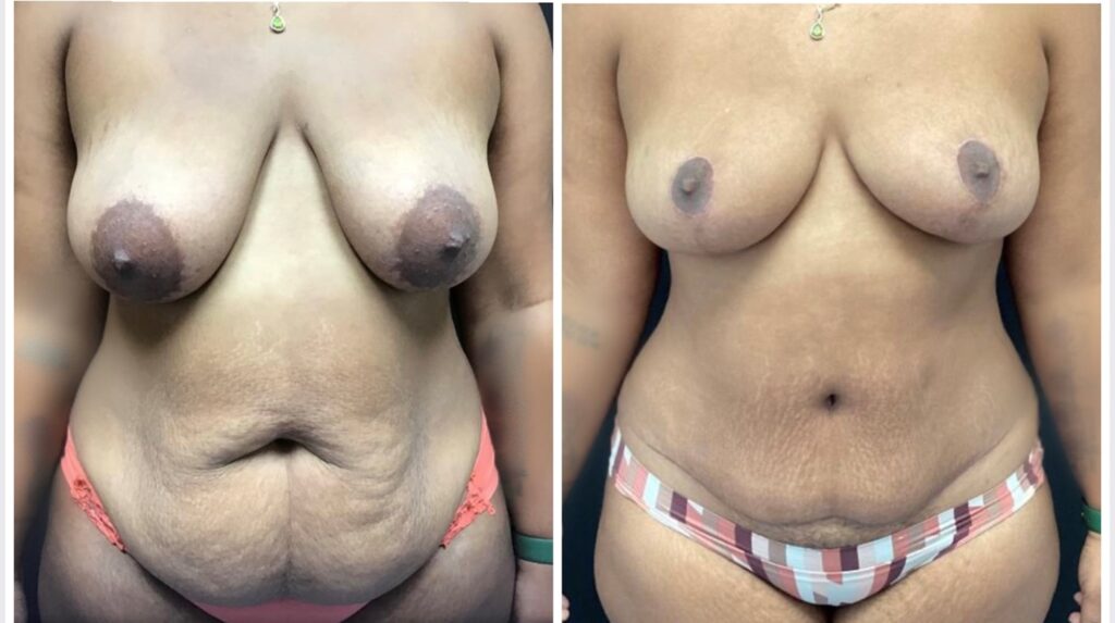 mommy makeover study photos 1