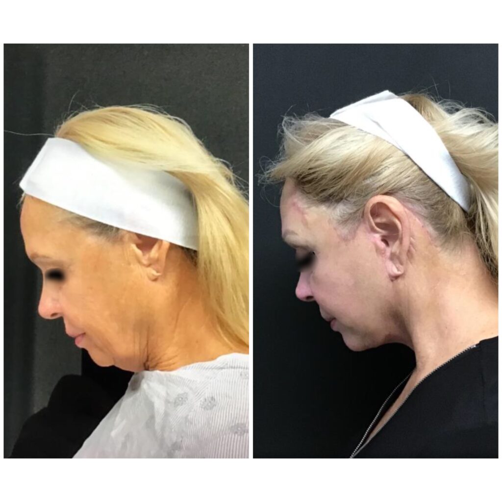 facelift side view