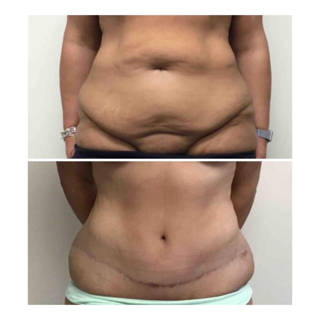 case study skin only tt