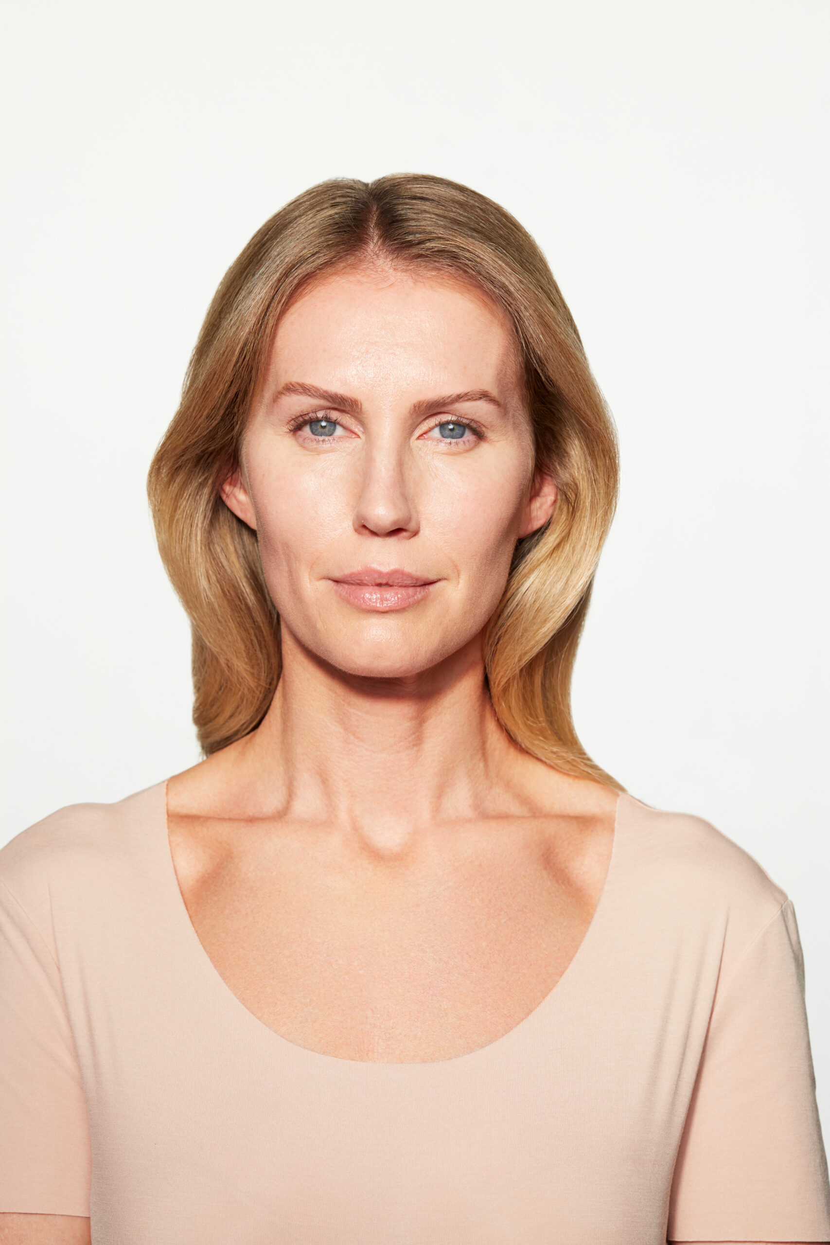chloe sculptra cheek 6 mo after facing forward