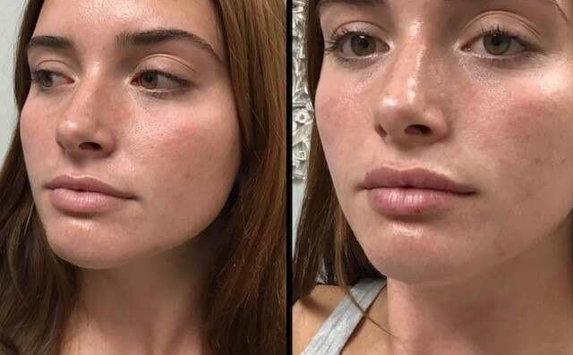 21yo-Lip-filler