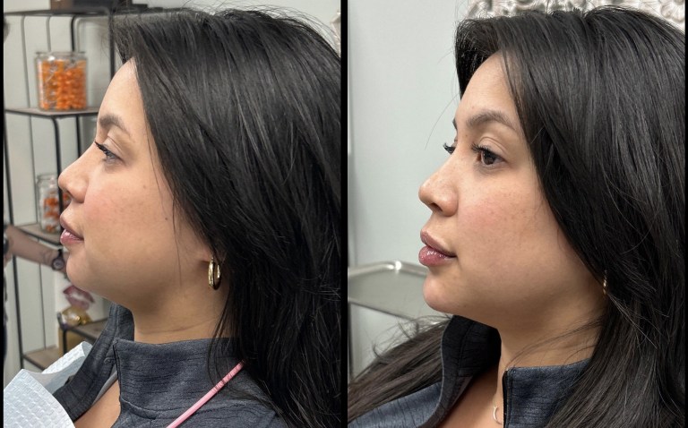 29-yo-Filler-lips-and-chin