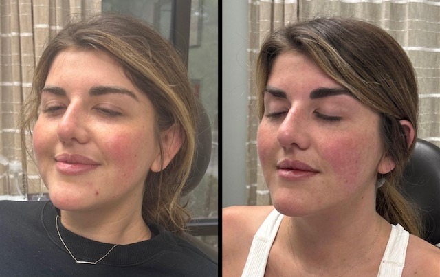 29-yo-filler-to-chin-and-cheeks.-Preventative-Botox-to-forehead