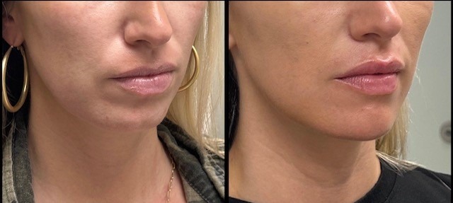 33-yr-filler-to-lips-and-chin