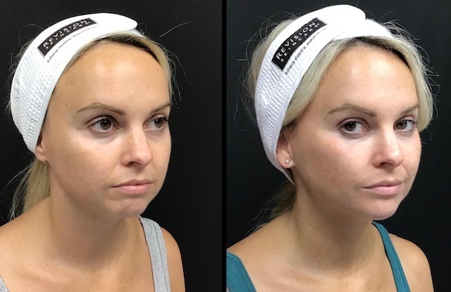 36-yo-Botox-and-Filler-to-cheeks-and-chin