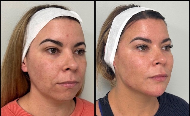 38yo-10-pt-lift-with-filler-pic-1