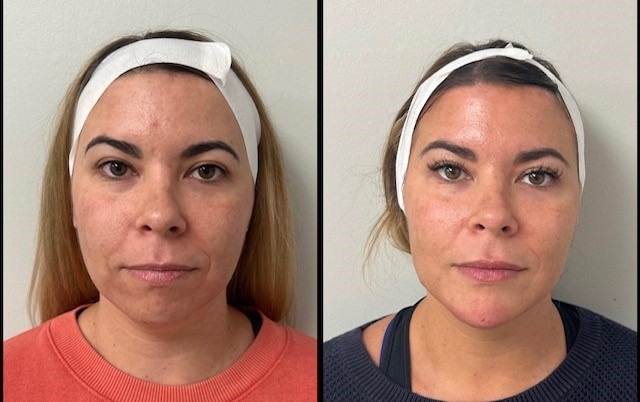 38yo-10-pt-lift-with-filler-pic-2