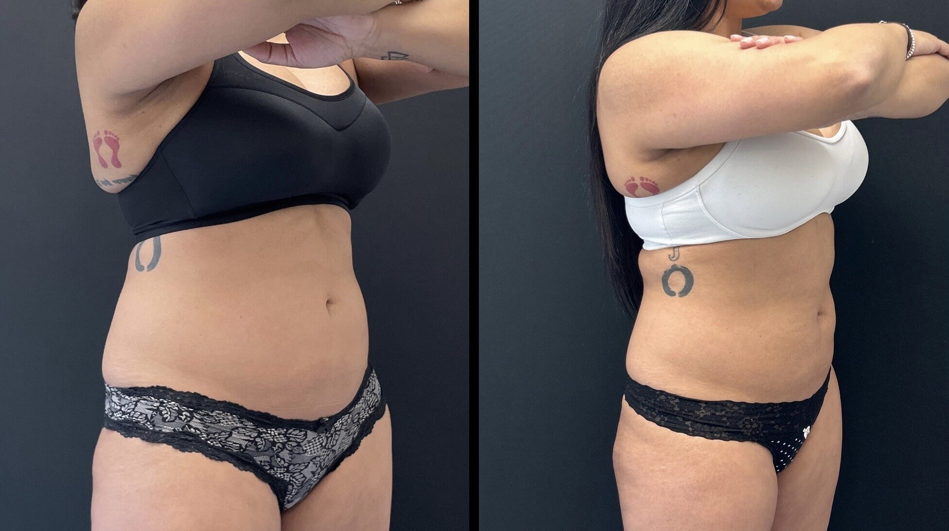 39-yo-Flex-to-abdomen-pic-2