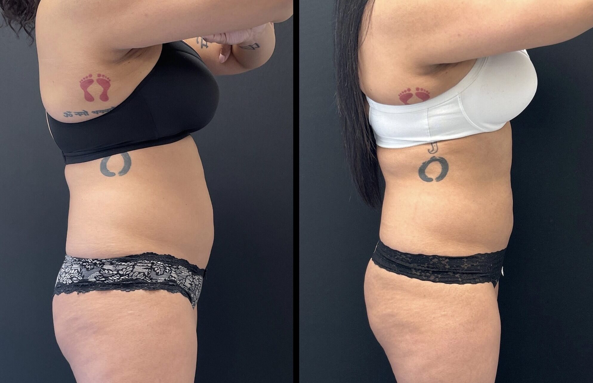 39-yo-Flex-to-abdomen-pic-3