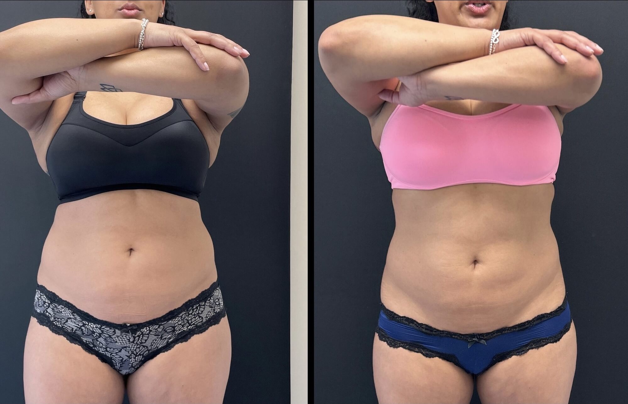 39-yo-flex-to-abdomen-pic-1