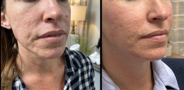 39-yr-filler-to-cheeks-and-scarring