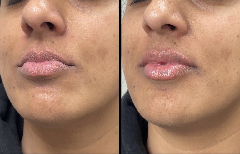 39yo-lip-filler