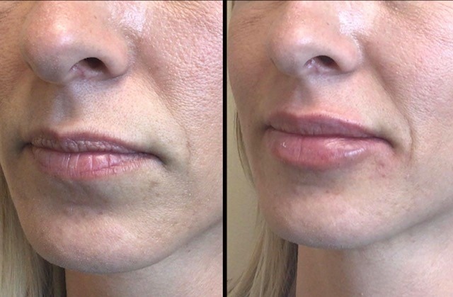 40-yr-lip-filler