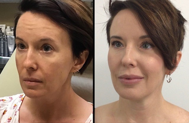 46-yo-Botox-filler-to-cheeks-and-lips