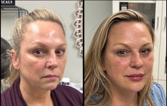 50-yo-Filler-10pt-lift-pic-1