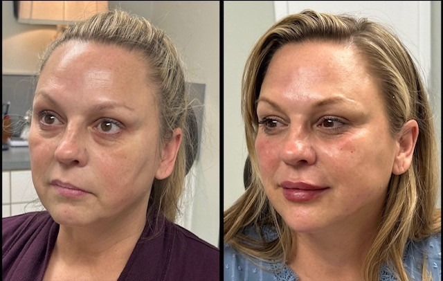 50-yo-Filler-10pt-lift-pic-2