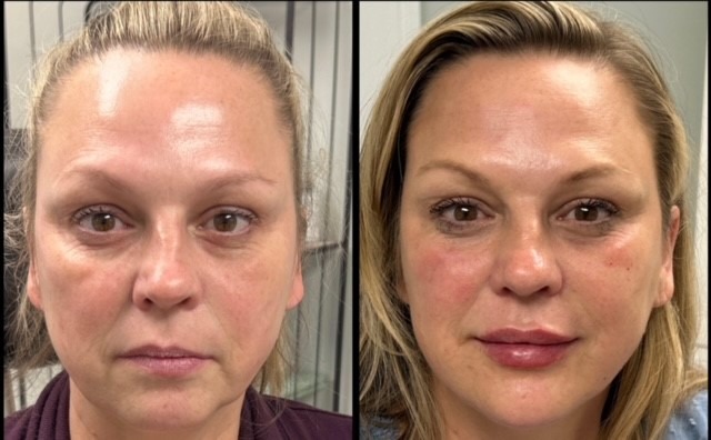 50-yo-Filler-10pt-lift-pic-3