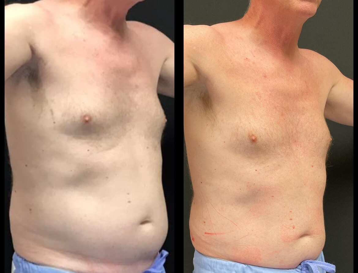 61-yo-Flex-to-abdomen-pic-1