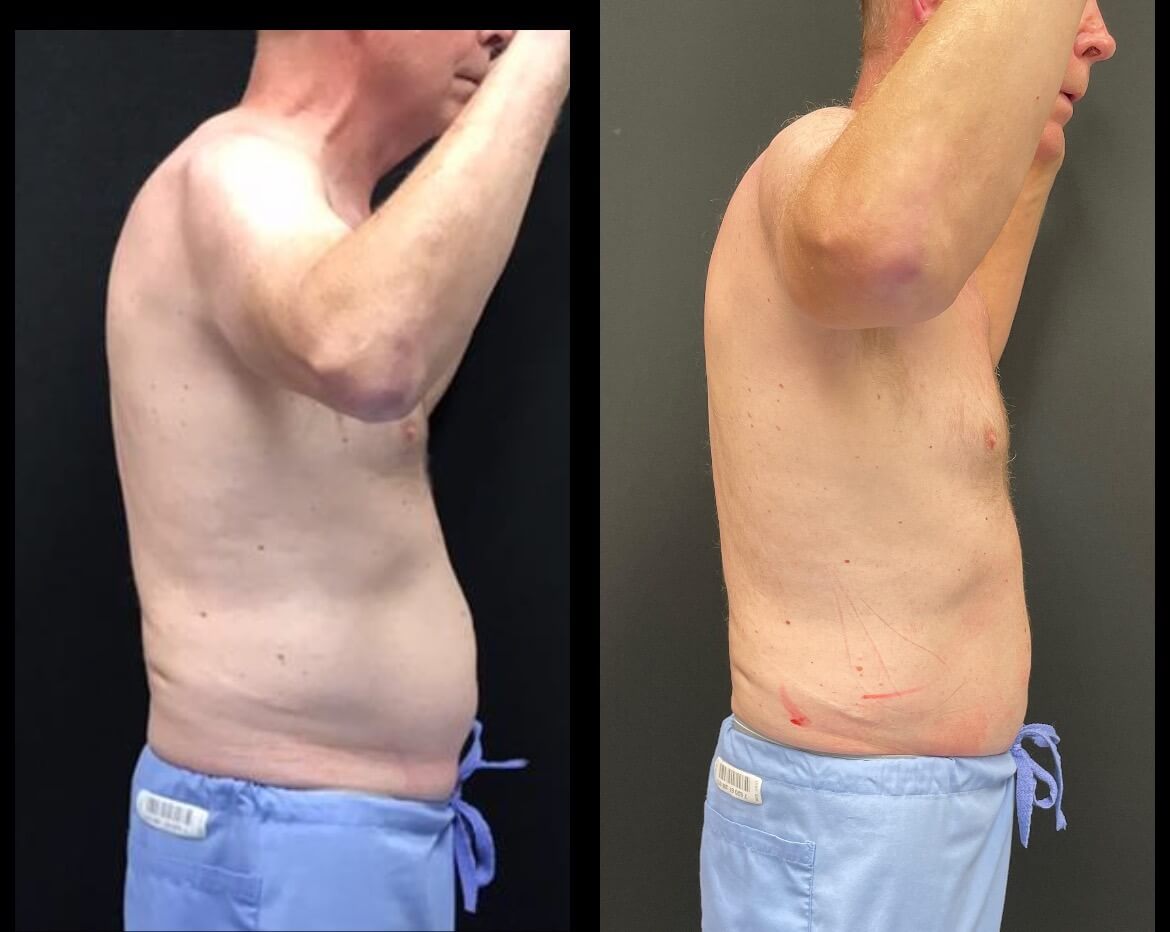 61-yo-Flex-to-abdomen-pic-2