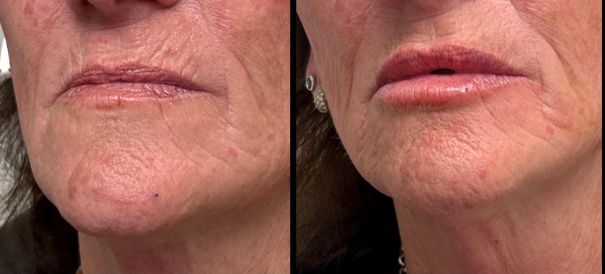 62yo-Filler-to-lips-and-lip-lines