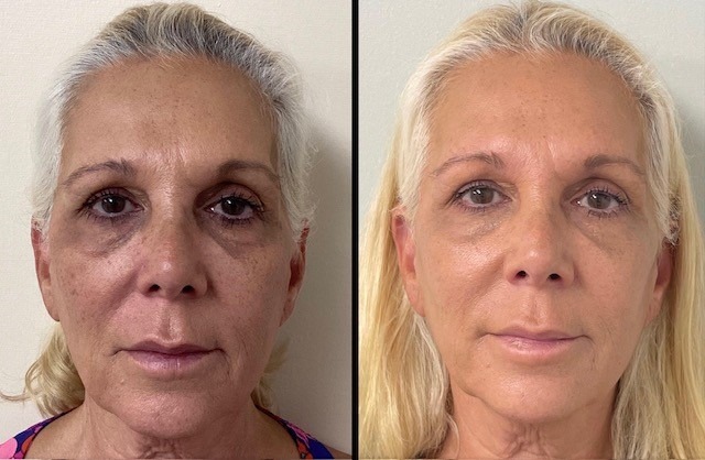 63yo-Botox-and-Filler-to-cheek-chin-and-nasolabial-folds-pic-2