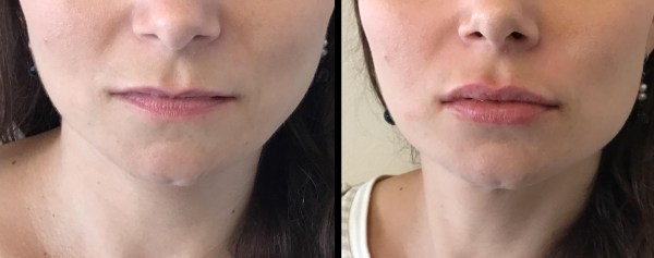Juvoderm-lips-3