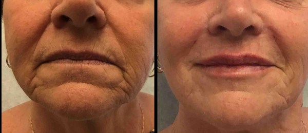 Juvoderm-lips-nasolabial-fold-cheeks