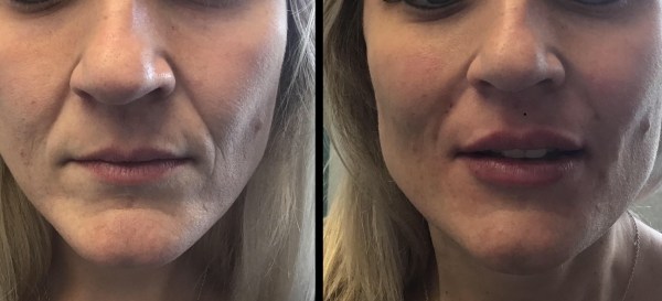Juvoderm-lips-nasolabial