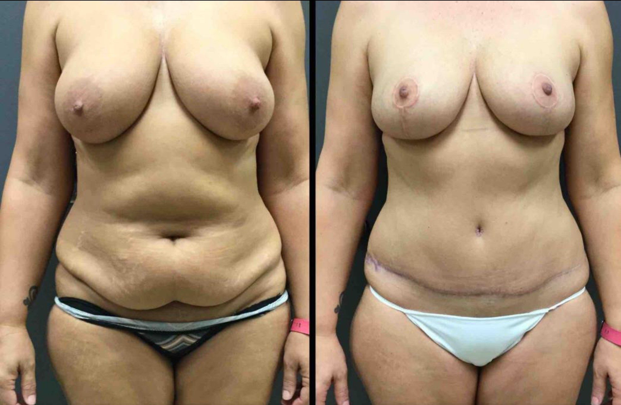 MommyMakeover2-e1545412059407