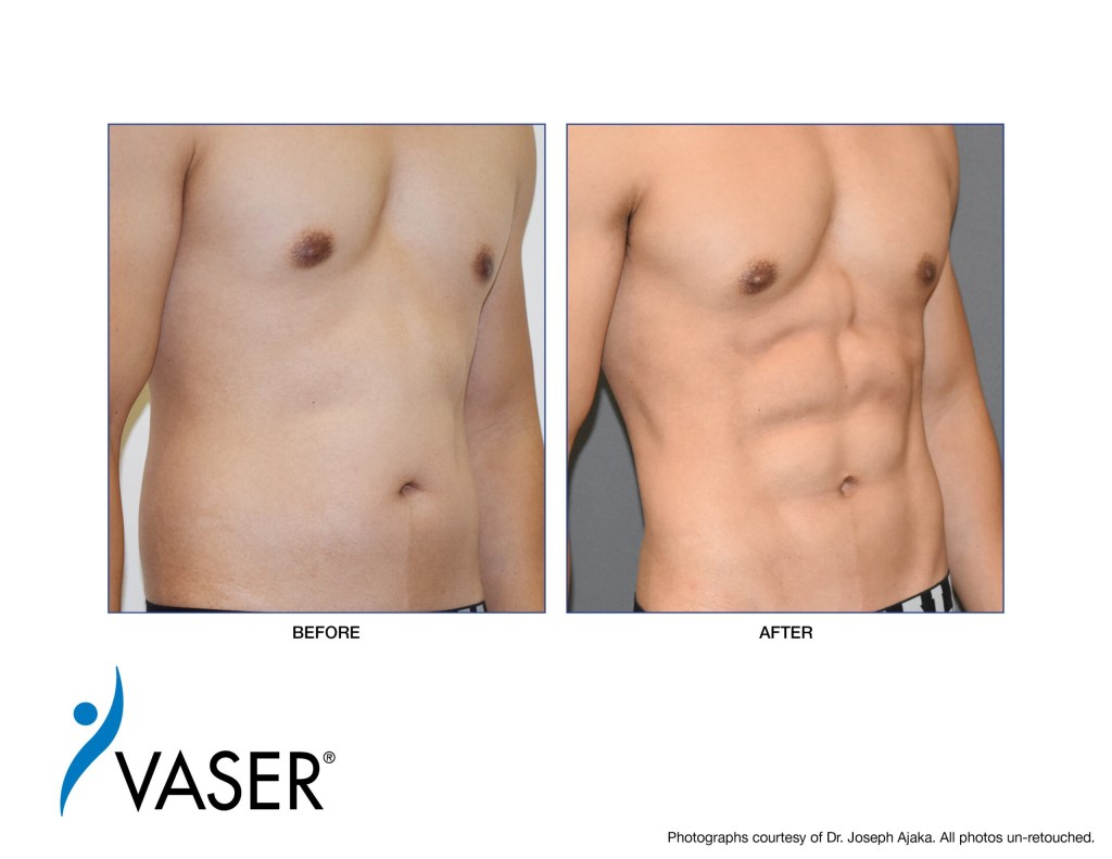 VASER-Ajaka-Before-After01-scaled