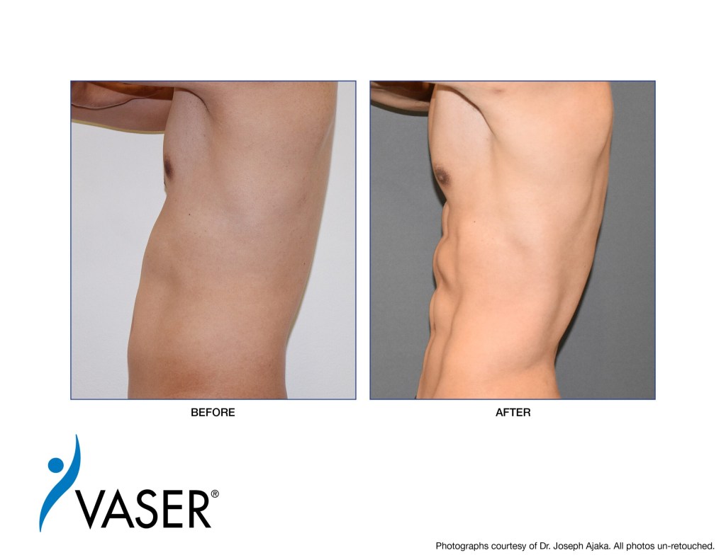 VASER-Ajaka-Before-After04-scaled