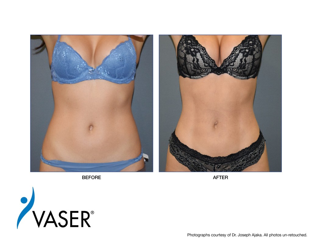 VASER-Ajaka-Before-After05-scaled