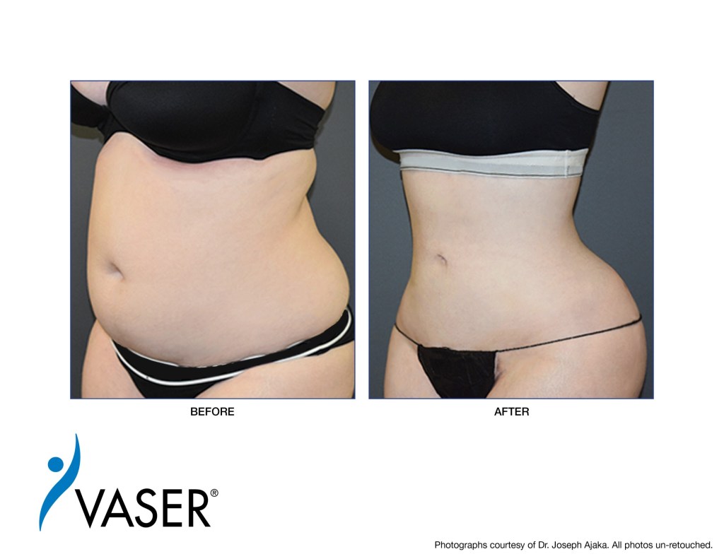 VASER-Ajaka-Before-After07-scaled