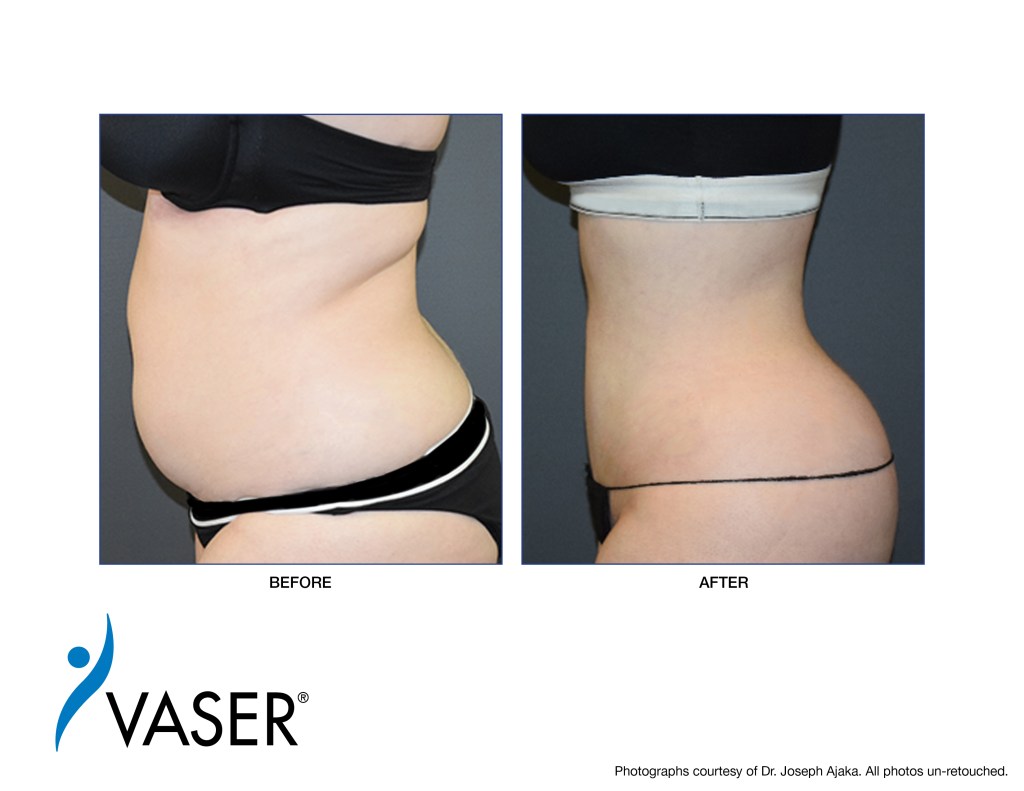 VASER-Ajaka-Before-After08