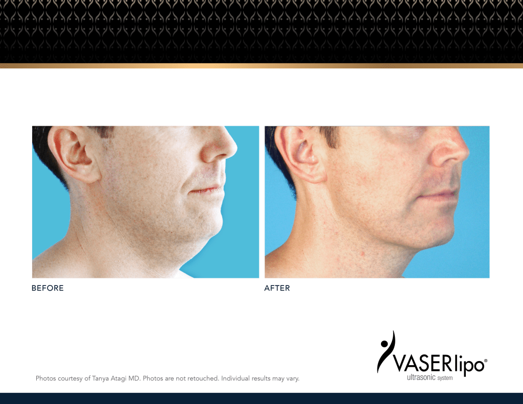 VASER_Atagi-BeforeAfters-20233