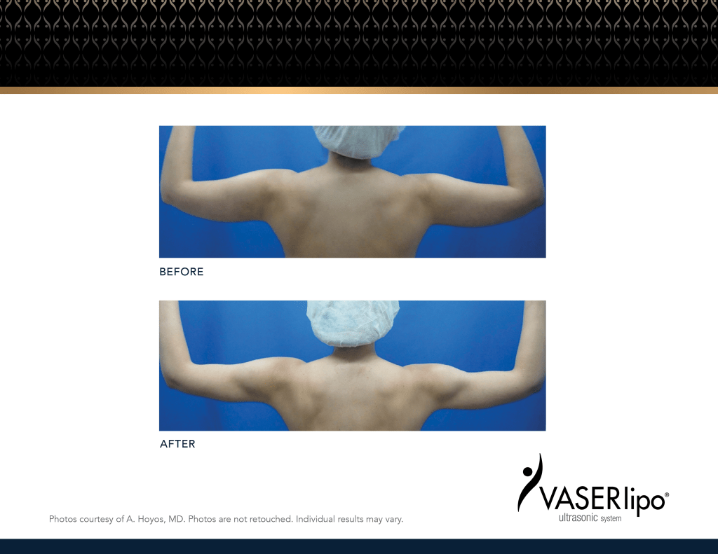 VASER_Hoyos-BeforeAfters-2023