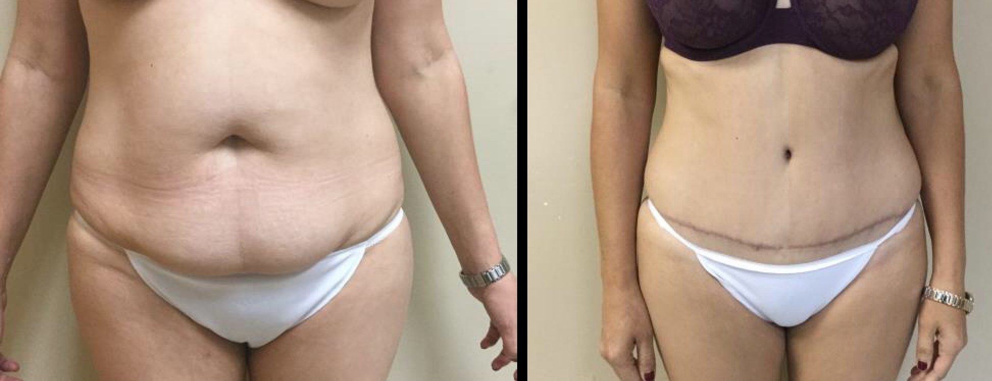 abdominoplasty2-e1546030373495