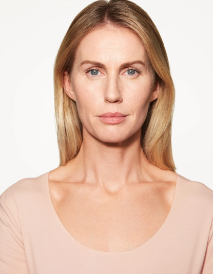 chloe-sculptra-cheek-3-mo-after-facing-forward-scaled