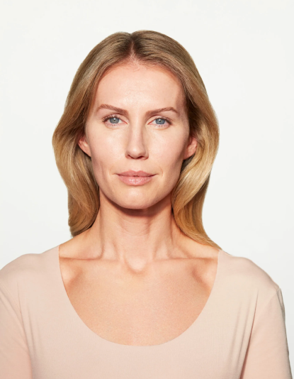 chloe-sculptra-cheek-6-mo-after-facing-forward-scaled