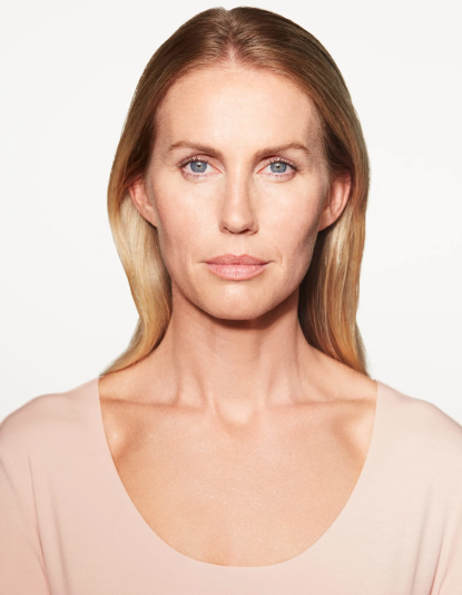 chloe-sculptra-cheek-before-facing-forward-scaled