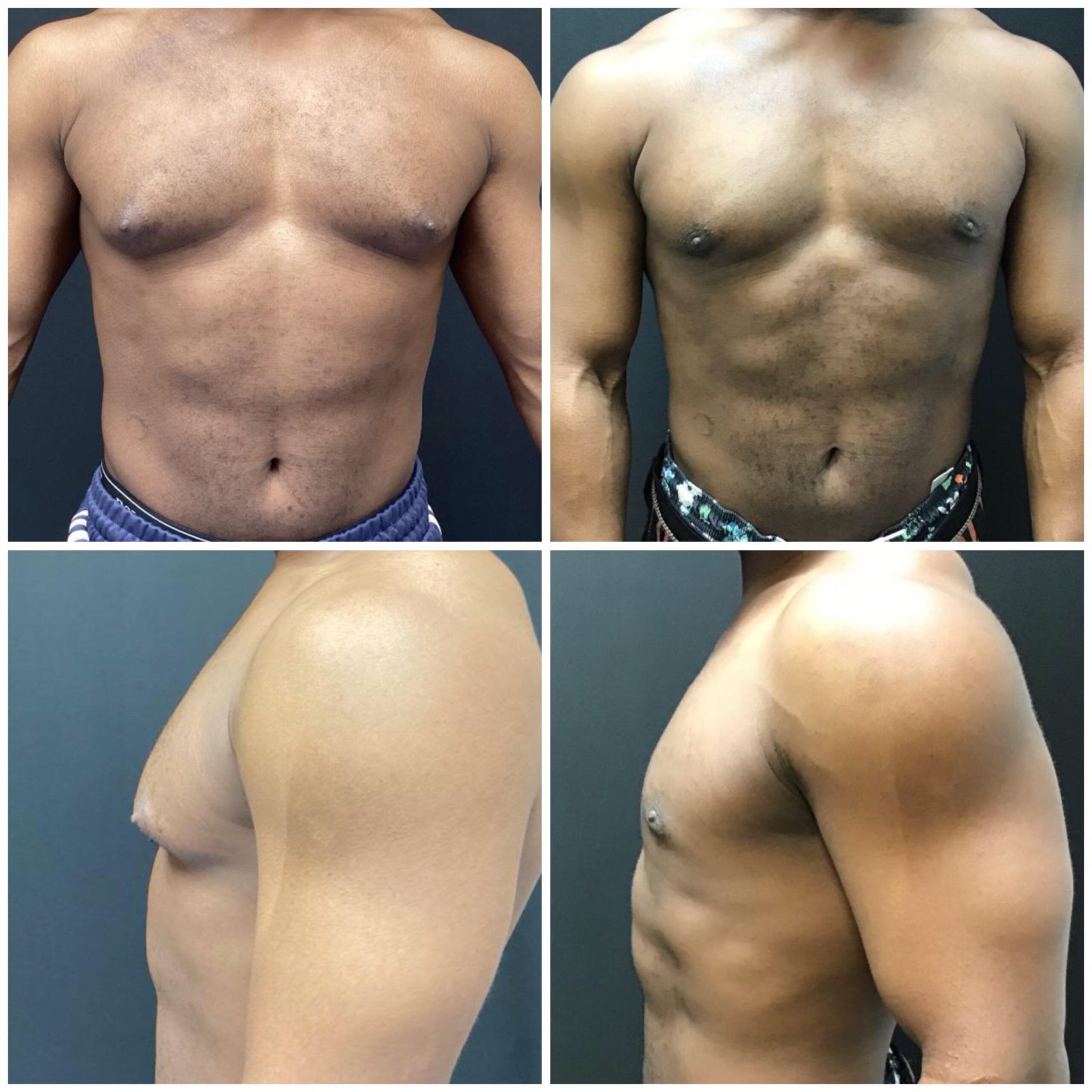 gynecomastia-before-and-afters-25yr-old-male-1-scaled