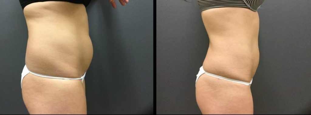 liposuction-flanks-abdomen-e1545412353163