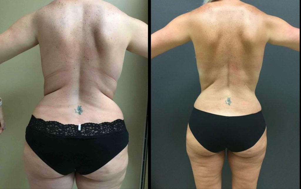 liposuction-flanks-thighs-e1545412342442