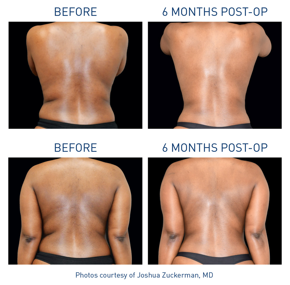 mm00558-00-renuvion-before-after-zuckerman-body-72dpi