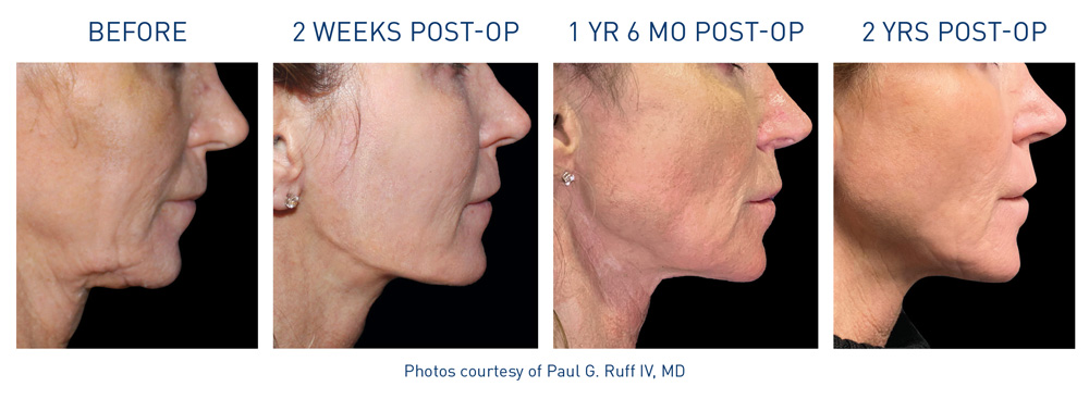 mm0150.06-renuvion-ba-neck-1-flyer-ruff_72dpi